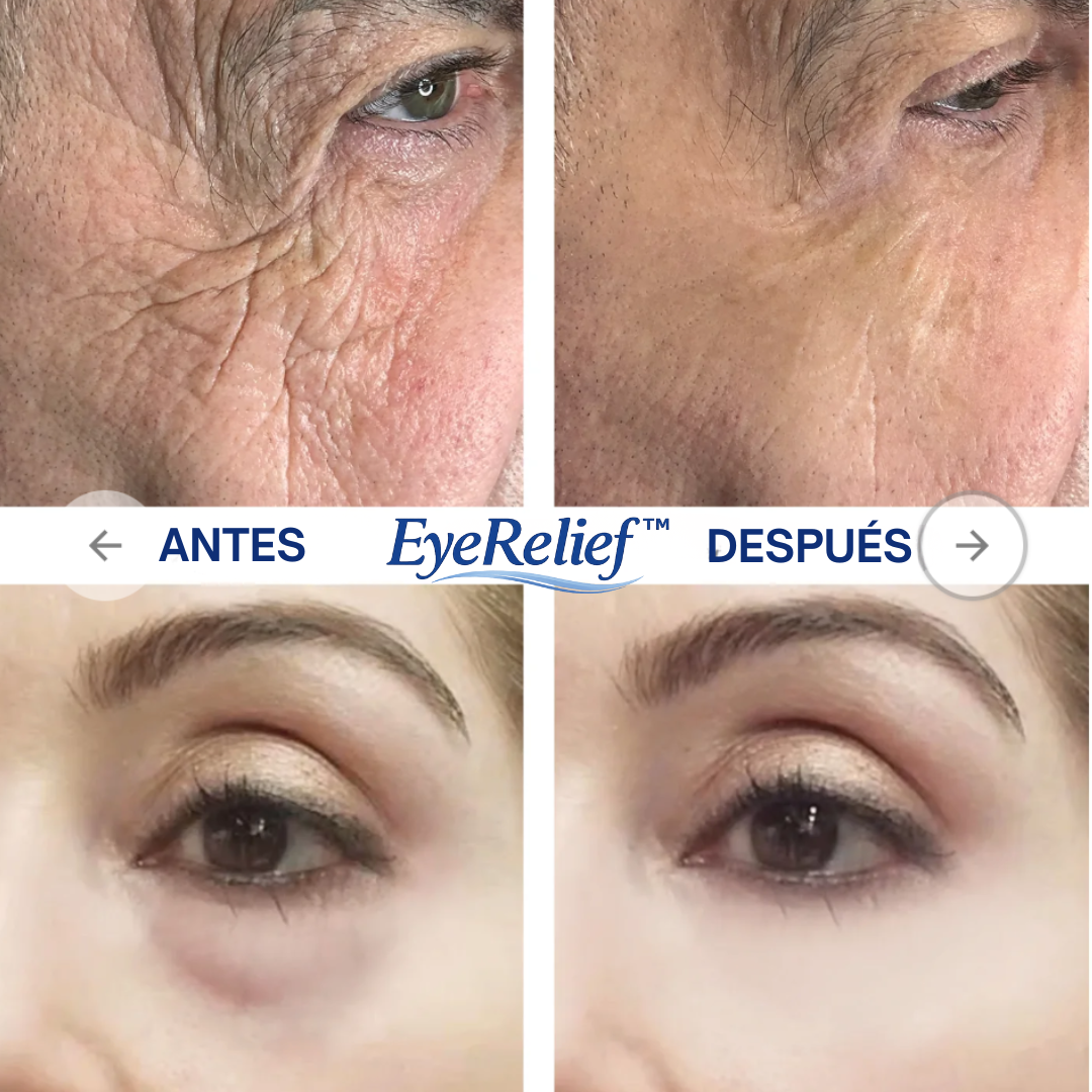 Alivio para bolsas, ojeras y ojos cansados - EyeRelief™